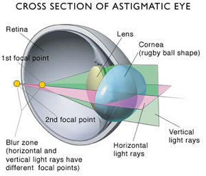 astigmatisme torisch cylindrisch ovaal oog rugbybal3
