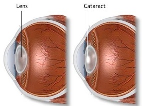 cataract-afbeelding