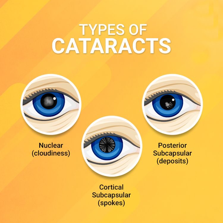 soorten cataract 2021-09